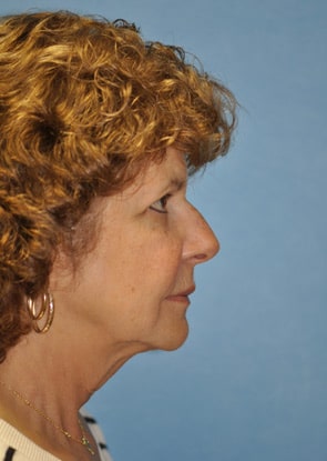 non surgical rhinoplasty