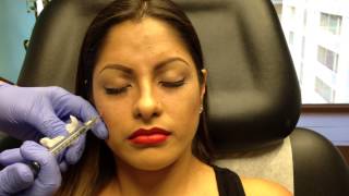 Botox & Juvederm Voluma Injections for Young Women