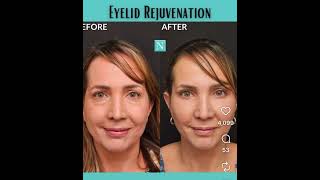 Blepharoplasty