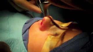 Closed septoplasty, Turbinate Reduction, rhinoplasty (part 1 of 2)