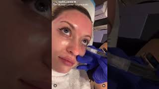 Facial Rejuvenation