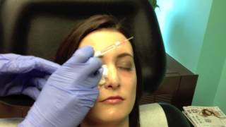 Dark Under Eye Circle Tear Trough Injections Chevy Chase Maryland