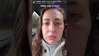 Dramatic Under-Eye Bag Transformation in 2.5 Months! 🤩