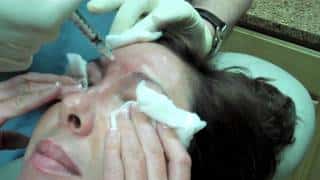 Dysport Injection to frown lines, forehead, crows feet, lower lids and nose bunny lines