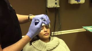 Dysport & Restylane Lyft Injection by Dr. Naderi to Forehead Wrinkles & Liquid Cheek Lift