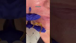 Get rid of broken capillaries