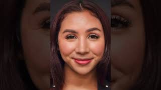 Hispanic / Latin Rhinoplasty Patient Before & After