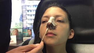 How to clean your nose after rhinoplasty