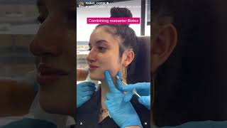 Jaw slimming & Chin projection Masseter Botox and Filler