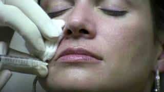 Juvederm Ultra Injection to NasoLabial Folds (laugh lines)