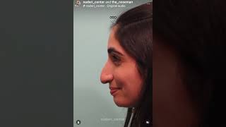 Middle Eastern Rhinoplasty Patient Before & After