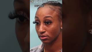 Natural Refinement: African American Rhinoplasty Before & After