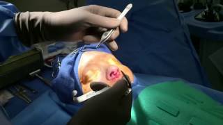 Rhinoplasty Demonstration