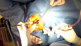 Open Rhinoplasty – (Part 2) Incisions to “open” the nose Washington DC