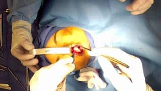 Open Rhinoplasty – (Part 3) Evaluation of Nasal Tip Cartilages