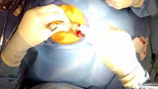 Open Rhinoplasty – (Part 4) Removal of Nasal Hump Chevy Chase Maryland