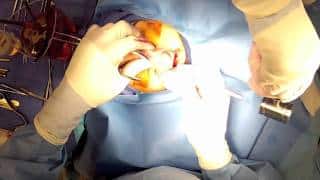 Open Rhinoplasty (Part 5) – Osteotomies: “Breaking the bones during a nose job”