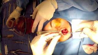 “Open” Rhinoplasty (Part 6) Narrowing nasal tip cartilages: Cephalic Trim