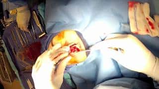 “Open” Rhinoplasty (Part 7) Dr. Naderi “droopy nose tip correction”