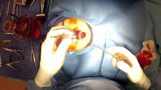 “Open” Rhinoplasty (Part 8) Dr. Naderi performs tip rhinoplasty sutures