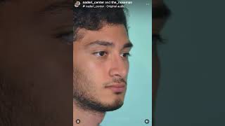 Persian Rhinoplasty Male Patient Before & After