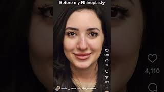 Persian Rhinoplasty Patient Before & After