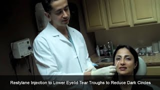 Restylane Injection to Lower Eyelid Tear Troughs to Reduce Dark Circles