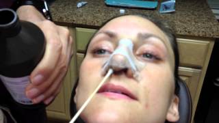 Rhinoplasty Recovery: (days 1 through 7) Nose Cleaning Instructions – Dr. Naderi