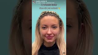 Smooth away forehead wrinkles with Dysport