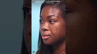 Non-Surgical Rhinoplasty