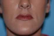 Virginia Lip Augmentation Front After in Herndon & Chevy Chase Virginia Lip Augmentation Front After in Herndon & Chevy Chase