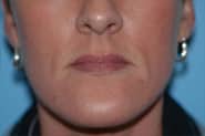 Virginia Lip Augmentation Front Before in Herndon & Chevy Chase Virginia Lip Augmentation Front Before in Herndon & Chevy Chase