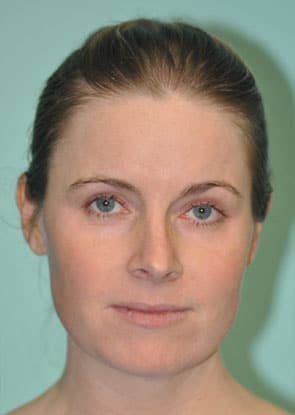 Frontal view after CO2 Laser resurfacing at The Naderi Center for Plastic Surgery and Dermatology | Virginia | Maryland
