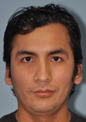 Front view after Septoplasty at The Naderi Center for Plastic Surgery and Dermatology | Virginia | Maryland