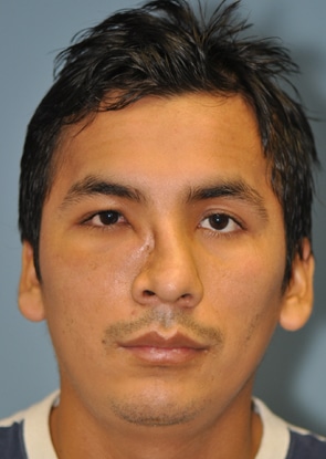 Front view before Septoplasty at The Naderi Center for Plastic Surgery and Dermatology | Virginia | Maryland
