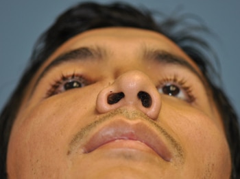 base view before Septoplasty at The Naderi Center for Plastic Surgery and Dermatology | Virginia | Maryland