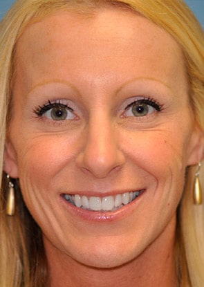Virginia Botox Front After in Herndon & Chevy Chase Virginia Botox Front After in Herndon & Chevy Chase