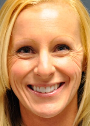Virginia Botox Front Before in Herndon & Chevy Chase Virginia Botox Front Before in Herndon & Chevy Chase