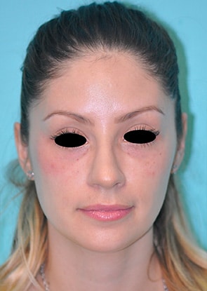 Virginia Botox Front After in Herndon & Chevy Chase Virginia Botox Front After in Herndon & Chevy Chase