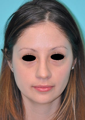Virginia Botox Front Before in Herndon & Chevy Chase Virginia Botox Front Before in Herndon & Chevy Chase