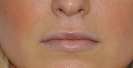 Virginia Lip Augmentation Front After in Herndon & Chevy Chase Virginia Lip Augmentation Front After in Herndon & Chevy Chase