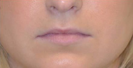 Virginia Lip Augmentation Front Before in Herndon & Chevy Chase Virginia Lip Augmentation Front Before in Herndon & Chevy Chase