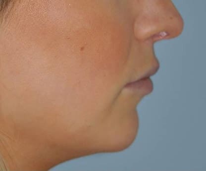 Virginia Lip Augmentation Lateral After in Herndon & Chevy Chase Virginia Lip Augmentation Lateral After in Herndon & Chevy Chase