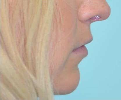 Virginia Lip Augmentation Lateral Before in Herndon & Chevy Chase Virginia Lip Augmentation Lateral Before in Herndon & Chevy Chase