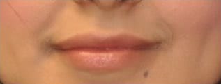 Virginia Lip Augmentation Front After in Herndon & Chevy Chase Virginia Lip Augmentation Front After in Herndon & Chevy Chase