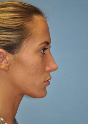 Herndon and Chevy Chase nasal anatomy