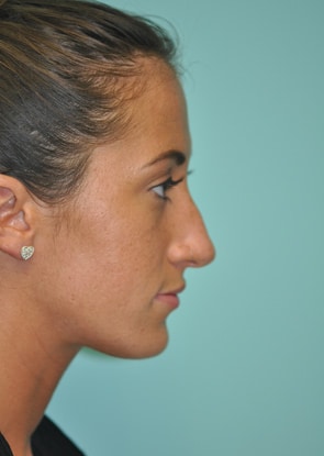 Herndon and Chevy Chase nasal anatomy