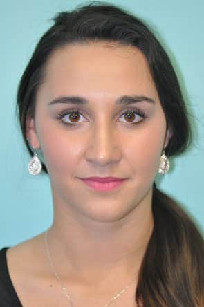 Herndon and Chevy Chase nasal anatomy