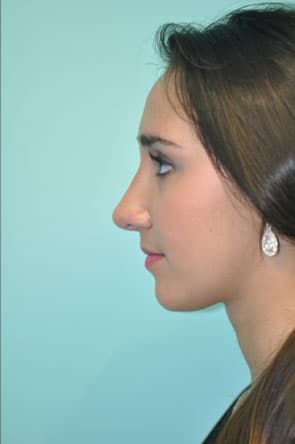 Herndon and Chevy Chase nasal anatomy