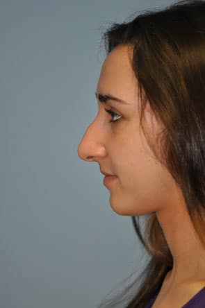 Herndon and Chevy Chase nasal anatomy
